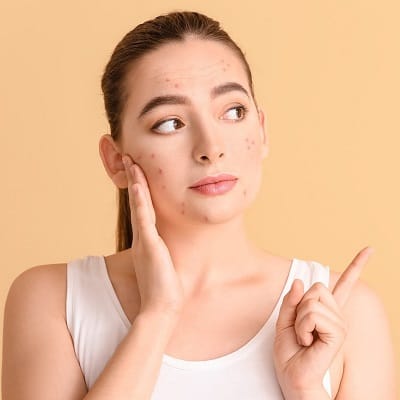 pimples treatment in Dubai
