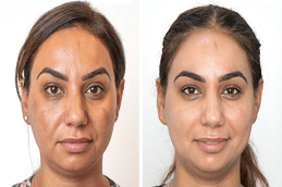 Before and after Mesotherapy treatment in Dubai