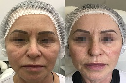 Before and after Oxygeneo facial in Dubai