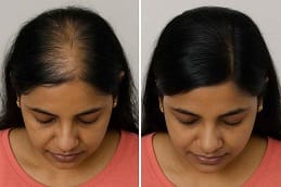 Mesotherapy treatment Dubai before and after