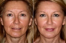 Mesotherapy treatment in Dubai before and after