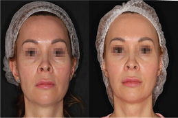 Oxygeneo facial Dubai before and after