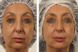 Oxygeneo facial in Dubai before and after