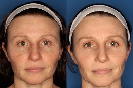 Pico Laser Treatment Dubai After and Before