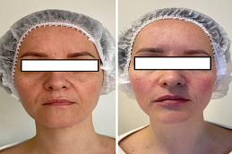 RF Microneedling in Dubai before and after