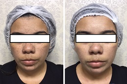 before and after RF Microneedling in Dubai