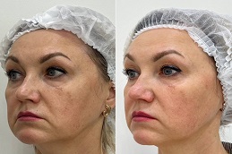 skin resurfacing Dubai before and after